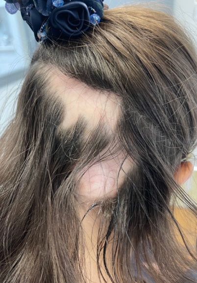 female-alopecia