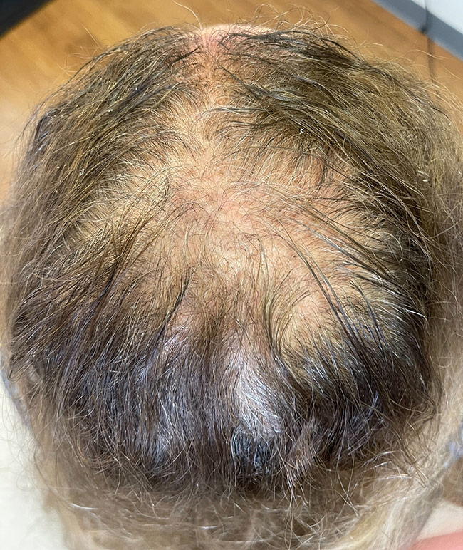 female-hair-loss