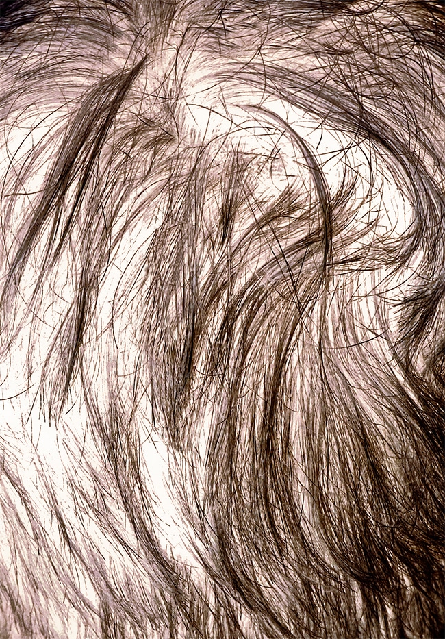 female-thinning-hair